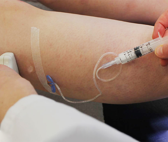Varicose Veins & Spider Veins